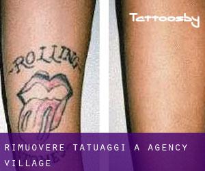 Rimuovere Tatuaggi a Agency Village