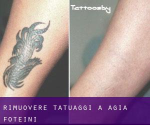 Rimuovere Tatuaggi a Agía Foteiní