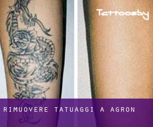 Rimuovere Tatuaggi a Agrón