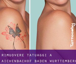 Rimuovere Tatuaggi a Aichenbachof (Baden-Württemberg)