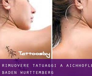 Rimuovere Tatuaggi a Aichhöfle (Baden-Württemberg)