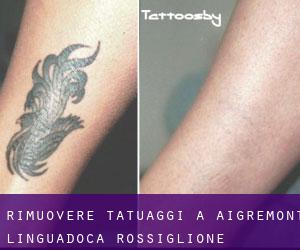 Rimuovere Tatuaggi a Aigremont (Linguadoca-Rossiglione)