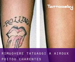 Rimuovere Tatuaggi a Airoux (Poitou-Charentes)