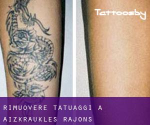 Rimuovere Tatuaggi a Aizkraukles Rajons