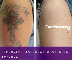 Rimuovere Tatuaggi a Ak Chin (Arizona)