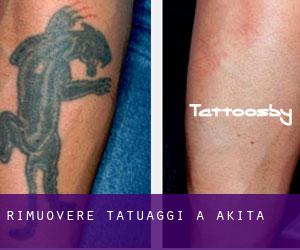 Rimuovere Tatuaggi a Akita
