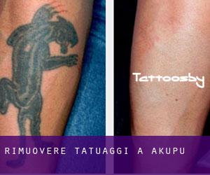 Rimuovere Tatuaggi a Akupu