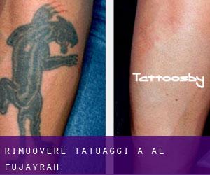 Rimuovere Tatuaggi a Al Fujayrah