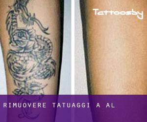 Rimuovere Tatuaggi a Ål