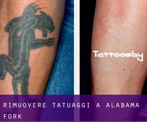 Rimuovere Tatuaggi a Alabama Fork