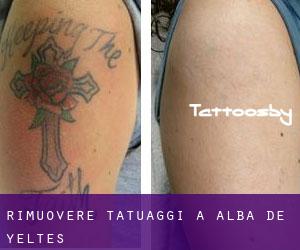 Rimuovere Tatuaggi a Alba de Yeltes