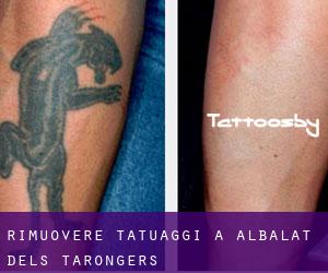 Rimuovere Tatuaggi a Albalat dels Tarongers