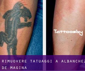 Rimuovere Tatuaggi a Albanchez de Mágina