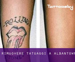 Rimuovere Tatuaggi a Albantown