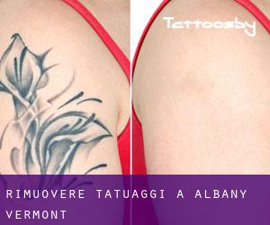 Rimuovere Tatuaggi a Albany (Vermont)