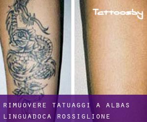 Rimuovere Tatuaggi a Albas (Linguadoca-Rossiglione)
