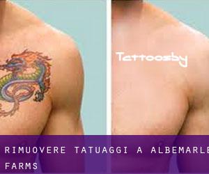 Rimuovere Tatuaggi a Albemarle Farms
