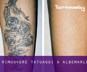 Rimuovere Tatuaggi a Albemarle