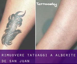 Rimuovere Tatuaggi a Alberite de San Juan