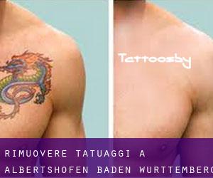 Rimuovere Tatuaggi a Albertshofen (Baden-Württemberg)