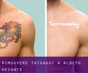 Rimuovere Tatuaggi a Albeth Heights