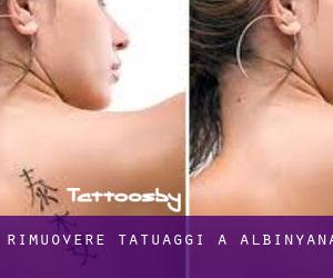 Rimuovere Tatuaggi a Albinyana