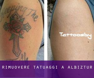 Rimuovere Tatuaggi a Albiztur