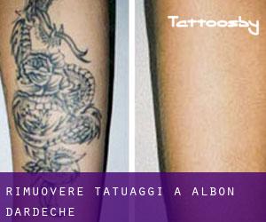 Rimuovere Tatuaggi a Albon-d'Ardèche