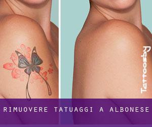 Rimuovere Tatuaggi a Albonese