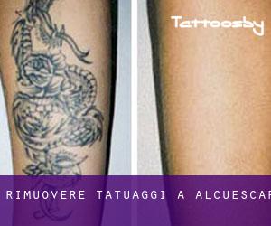 Rimuovere Tatuaggi a Alcuéscar