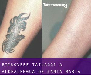 Rimuovere Tatuaggi a Aldealengua de Santa María