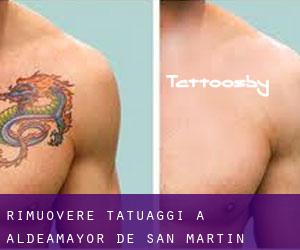 Rimuovere Tatuaggi a Aldeamayor de San Martín