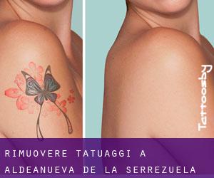 Rimuovere Tatuaggi a Aldeanueva de la Serrezuela