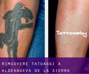 Rimuovere Tatuaggi a Aldeanueva de la Sierra