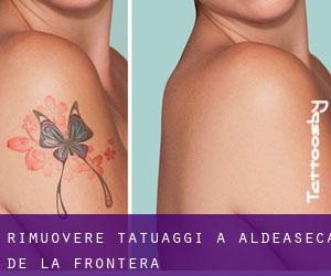 Rimuovere Tatuaggi a Aldeaseca de la Frontera