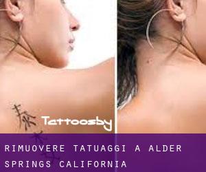 Rimuovere Tatuaggi a Alder Springs (California)