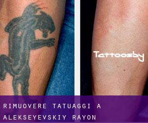 Rimuovere Tatuaggi a Alekseyevskiy Rayon