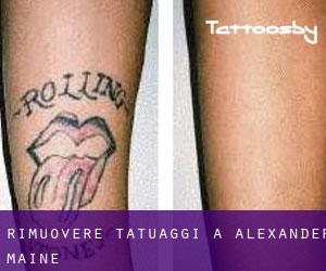 Rimuovere Tatuaggi a Alexander (Maine)