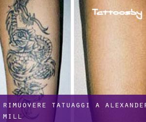 Rimuovere Tatuaggi a Alexander Mill