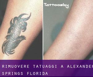 Rimuovere Tatuaggi a Alexander Springs (Florida)