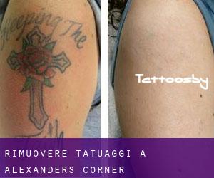 Rimuovere Tatuaggi a Alexanders Corner