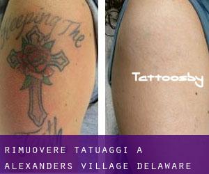 Rimuovere Tatuaggi a Alexanders Village (Delaware)