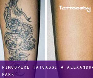 Rimuovere Tatuaggi a Alexandra Park