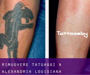 Rimuovere Tatuaggi a Alexandria (Louisiana)