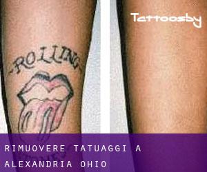 Rimuovere Tatuaggi a Alexandria (Ohio)