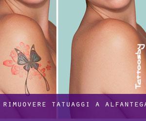 Rimuovere Tatuaggi a Alfántega