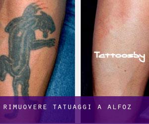 Rimuovere Tatuaggi a Alfoz