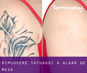 Rimuovere Tatuaggi a Algar de Mesa