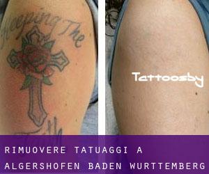 Rimuovere Tatuaggi a Algershofen (Baden-Württemberg)