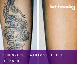 Rimuovere Tatuaggi a Ali Chukson